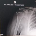 X-RAY OF PATIENT WITH CALCIFIC TENDINITIS
